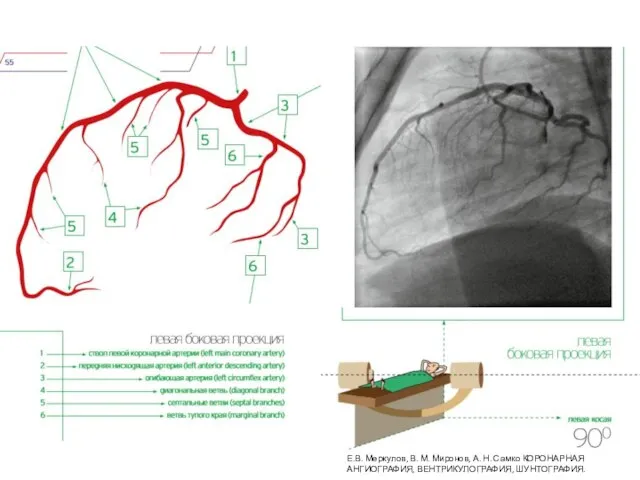 Е.В. Меркулов, В. М. Миронов, А. Н. Самко КОРОНАРНАЯ АНГИОГРАФИЯ, ВЕНТРИКУЛОГРАФИЯ, ШУНТОГРАФИЯ.