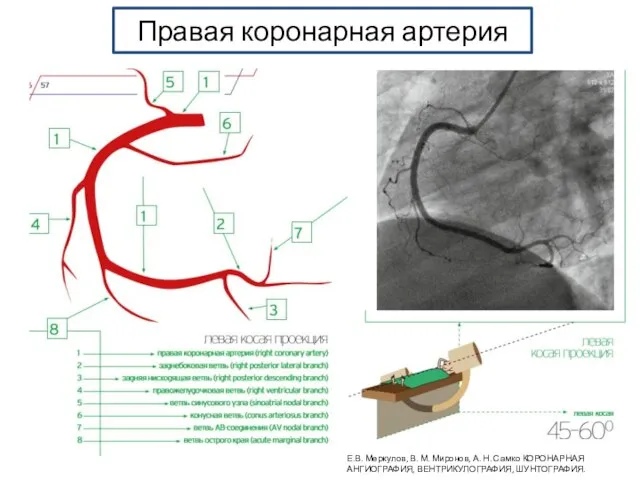 Правая коронарная артерия Е.В. Меркулов, В. М. Миронов, А. Н. Самко КОРОНАРНАЯ АНГИОГРАФИЯ, ВЕНТРИКУЛОГРАФИЯ, ШУНТОГРАФИЯ.