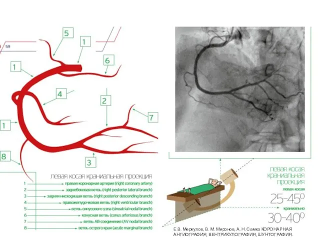 Е.В. Меркулов, В. М. Миронов, А. Н. Самко КОРОНАРНАЯ АНГИОГРАФИЯ, ВЕНТРИКУЛОГРАФИЯ, ШУНТОГРАФИЯ.