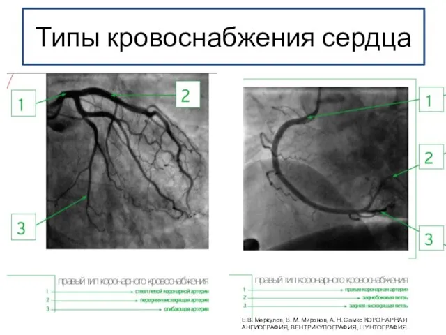 Типы кровоснабжения сердца Е.В. Меркулов, В. М. Миронов, А. Н. Самко КОРОНАРНАЯ АНГИОГРАФИЯ, ВЕНТРИКУЛОГРАФИЯ, ШУНТОГРАФИЯ.
