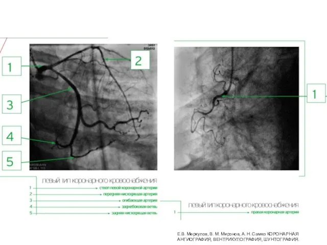 Е.В. Меркулов, В. М. Миронов, А. Н. Самко КОРОНАРНАЯ АНГИОГРАФИЯ, ВЕНТРИКУЛОГРАФИЯ, ШУНТОГРАФИЯ.