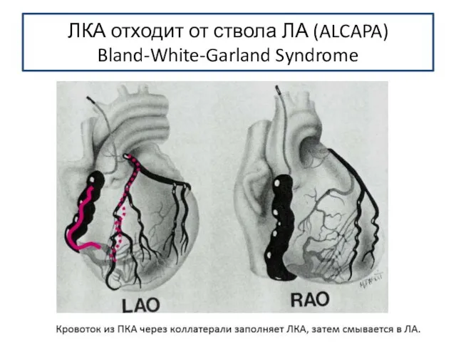 ЛКА отходит от ствола ЛА (ALCAPA) Bland-White-Garland Syndrome