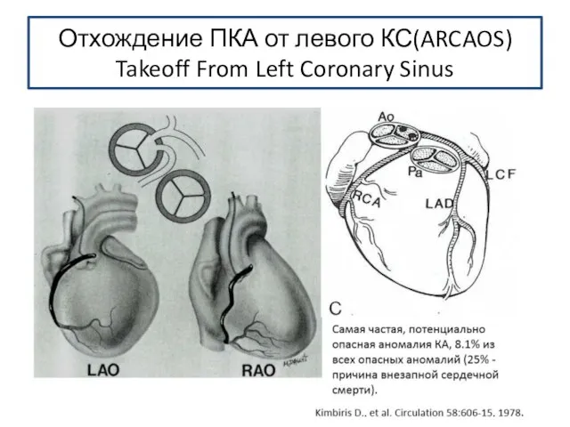 Отхождение ПКА от левого КС(ARCAOS) Takeoff From Left Coronary Sinus