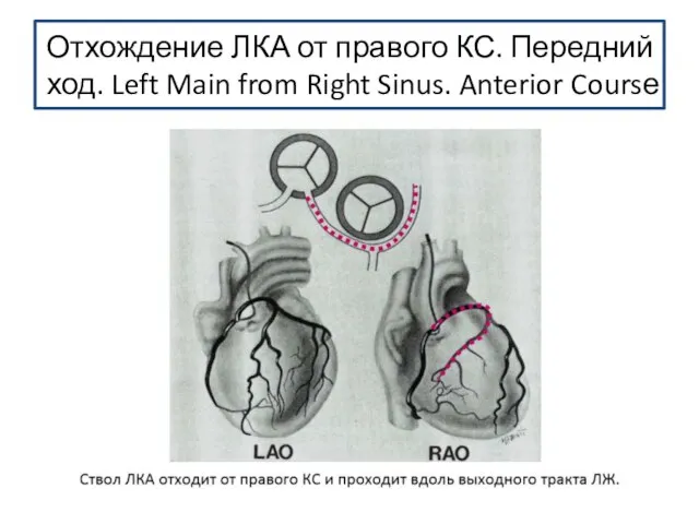 Отхождение ЛКА от правого КС. Передний ход. Left Main from Right Sinus. Anterior Coursе