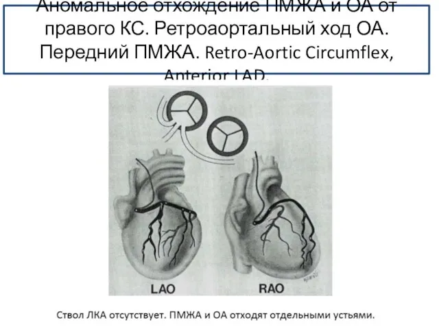 Аномальное отхождение ПМЖА и ОА от правого КС. Ретроаортальный ход ОА.