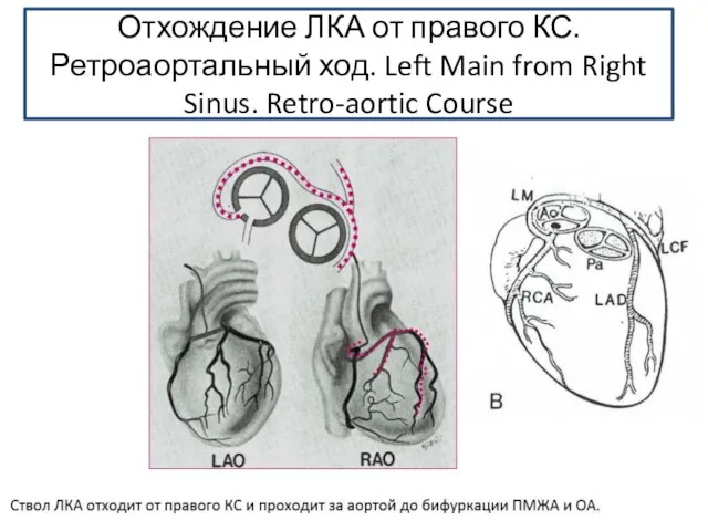 Отхождение ЛКА от правого КС. Ретроаортальный ход. Left Main from Right Sinus. Retro-aortic Course