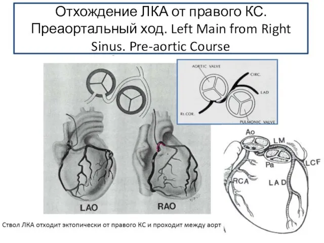 Отхождение ЛКА от правого КС. Преаортальный ход. Left Main from Right Sinus. Pre-aortic Course