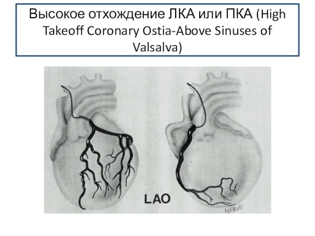 Высокое отхождение ЛКА или ПКА (High Takeoff Coronary Ostia-Above Sinuses of Valsalva)