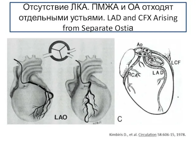 Отсутствие ЛКА. ПМЖА и ОА отходят отдельными устьями. LAD and CFX Arising from Separate Ostiа