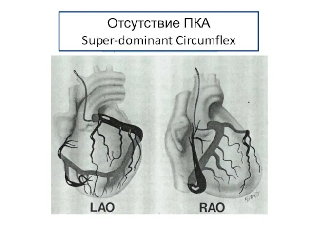 Отсутствие ПКА Super-dominant Circumflex