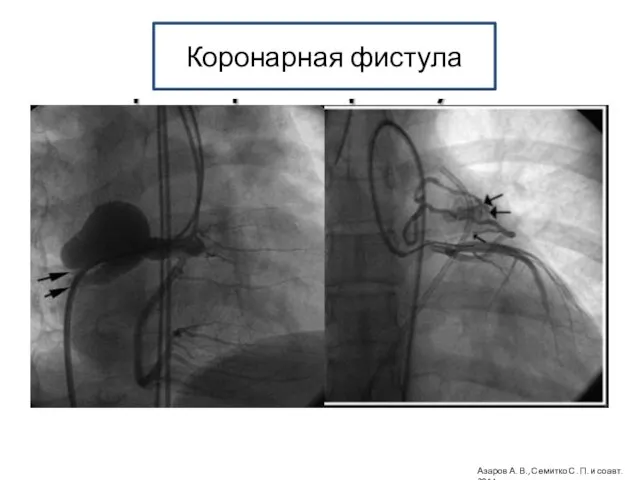 Коронарная фистула Азаров А. В., Семитко С. П. и соавт. 2014