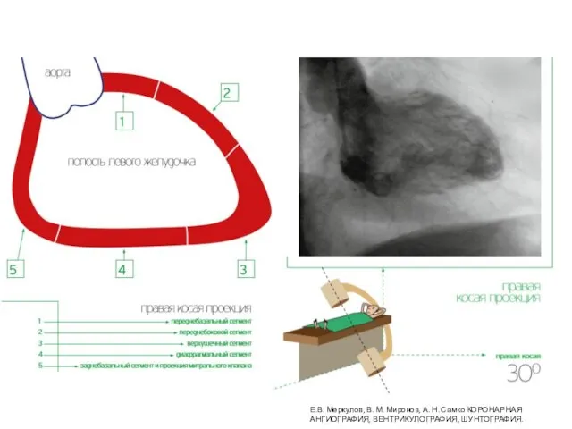 Е.В. Меркулов, В. М. Миронов, А. Н. Самко КОРОНАРНАЯ АНГИОГРАФИЯ, ВЕНТРИКУЛОГРАФИЯ, ШУНТОГРАФИЯ.