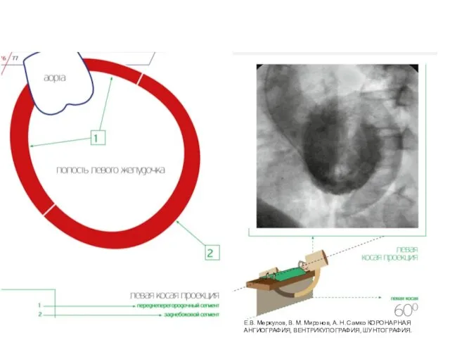 Е.В. Меркулов, В. М. Миронов, А. Н. Самко КОРОНАРНАЯ АНГИОГРАФИЯ, ВЕНТРИКУЛОГРАФИЯ, ШУНТОГРАФИЯ.