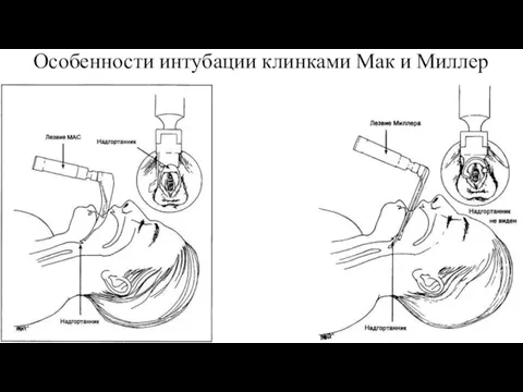 Особенности интубации клинками Мак и Миллер