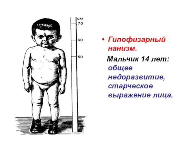 Гипофизарный нанизм. Мальчик 14 лет: общее недоразвитие, старческое выражение лица.