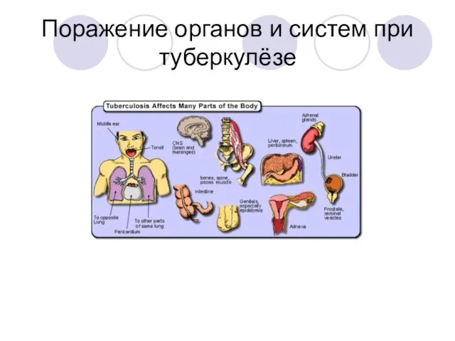 Поражение органов и систем при туберкулёзе