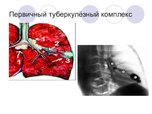 Первичный туберкулёзный комплекс