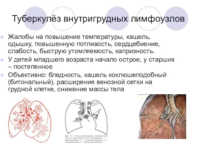 Туберкулёз внутригрудных лимфоузлов Жалобы на повышение температуры, кашель, одышку, повышенную потливость,