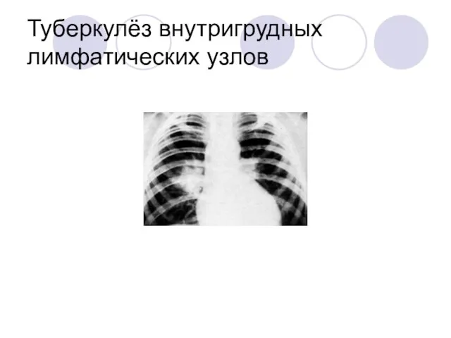 Туберкулёз внутригрудных лимфатических узлов