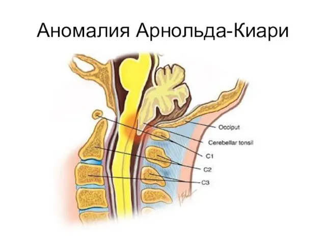 Аномалия Арнольда-Киари