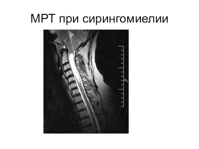 МРТ при сирингомиелии