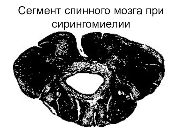 Сегмент спинного мозга при сирингомиелии