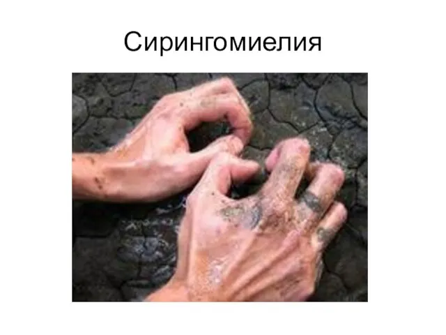 Сирингомиелия