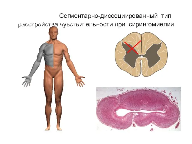 Сегментарно-диссоциированный тип расстройства чувствительности при сирингомиелии Поражение чччзаего рога см Часто