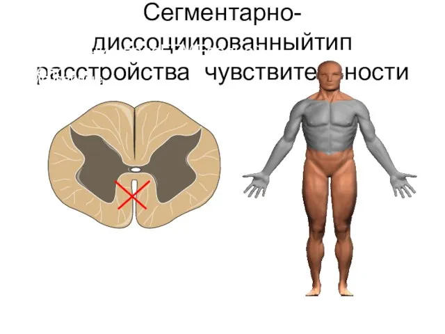 Сегментарно-диссоциированныйтип расстройства чувствительности Поражение персЕГМЕседней белр сегментарные диссоциированные расстройства чувствительности, но