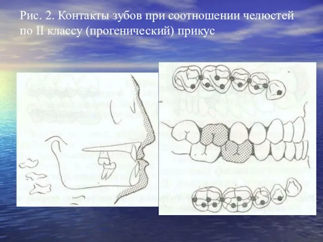 Рис. 2. Контакты зубов при соотношении челюстей по II классу (прогенический) прикус