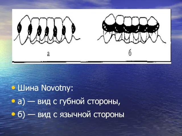Шина Novotny: a) — вид с губной стороны, б) — вид с язычной стороны