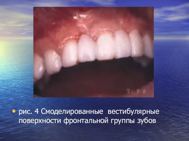 рис. 4 Смоделированные вестибулярные поверхности фронтальной группы зубов