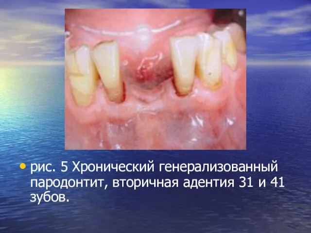 рис. 5 Хронический генерализованный пародонтит, вторичная адентия 31 и 41 зубов.