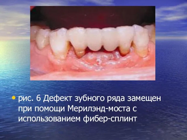 рис. 6 Дефект зубного ряда замещен при помощи Мерилэнд-моста с использованием фибер-сплинт