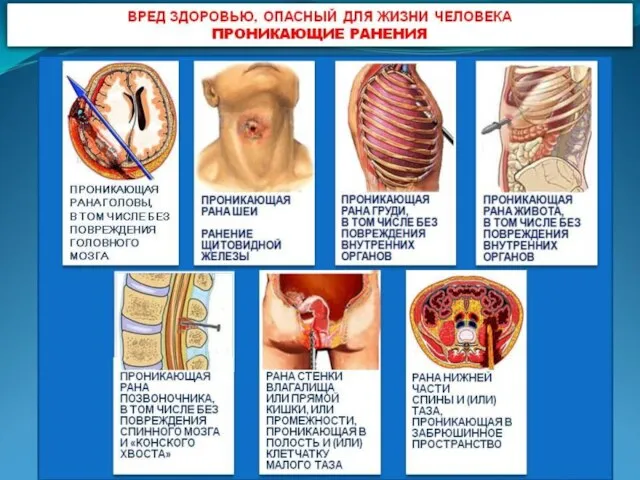 Вред здоровью, опасный для жизни человека