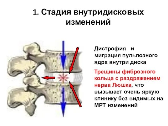 Дистрофия и миграция пульпозного ядра внутри диска Трещины фиброзного кольца с