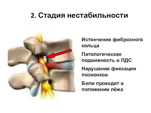 Истончение фиброзного кольца Патологическая подвижность в ПДС Нарушение фиксации позвонков Боли