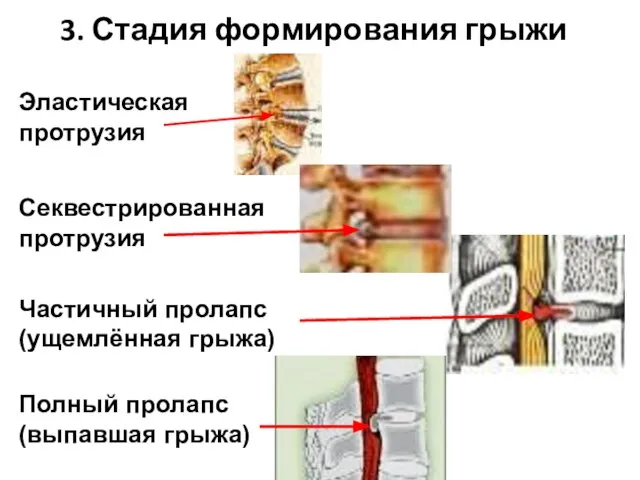 Эластическая протрузия Секвестрированная протрузия Частичный пролапс (ущемлённая грыжа) Полный пролапс (выпавшая грыжа) 3. Стадия формирования грыжи