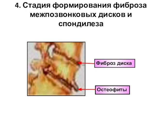 Фиброз диска Остеофиты 4. Стадия формирования фиброза межпозвонковых дисков и спондилеза