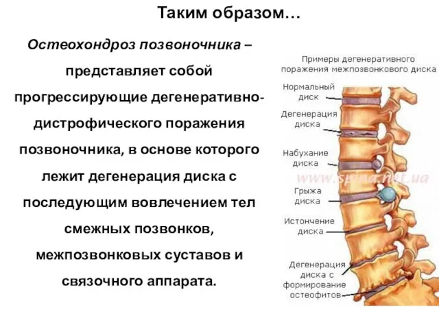 Остеохондроз позвоночника – представляет собой прогрессирующие дегенеративно-дистрофического поражения позвоночника, в основе