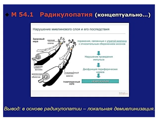 Радикулопатия