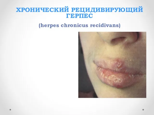 ХРОНИЧЕСКИЙ РЕЦИДИВИРУЮЩИЙ ГЕРПЕС (herpes chronicus recidivans)