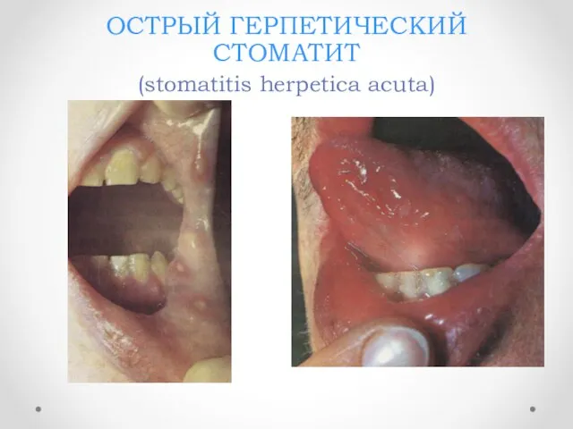 ОСТРЫЙ ГЕРПЕТИЧЕСКИЙ СТОМАТИТ (stomatitis herpetica асutа)