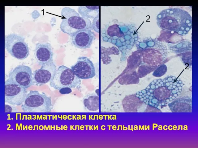 1. Плазматическая клетка 2. Миеломные клетки с тельцами Рассела 1 2 2