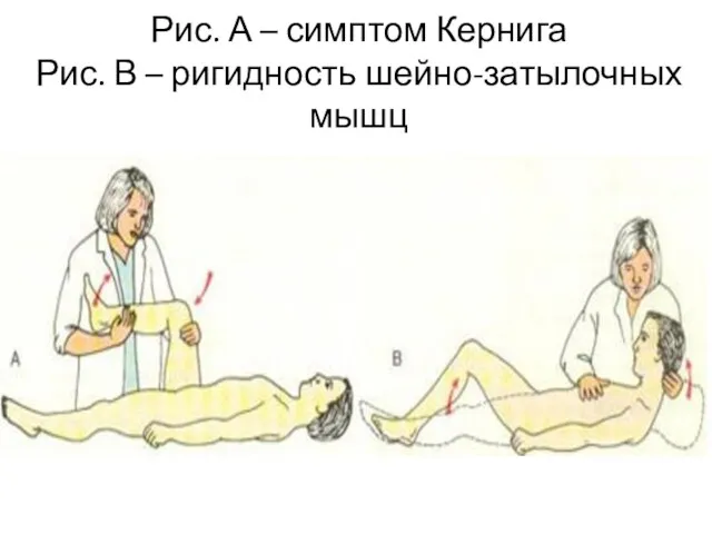 Рис. А – симптом Кернига Рис. В – ригидность шейно-затылочных мышц