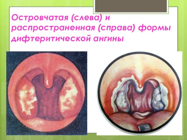 Островчатая (слева) и распространенная (справа) формы дифтеритической ангины