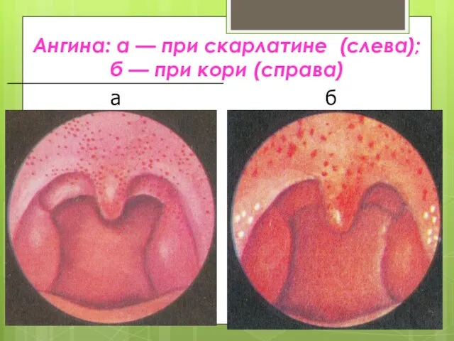 Ангина: а — при скарлатине (слева); б — при кори (справа)