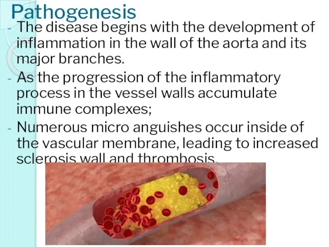 Pathogenesis The disease begins with the development of inflammation in the