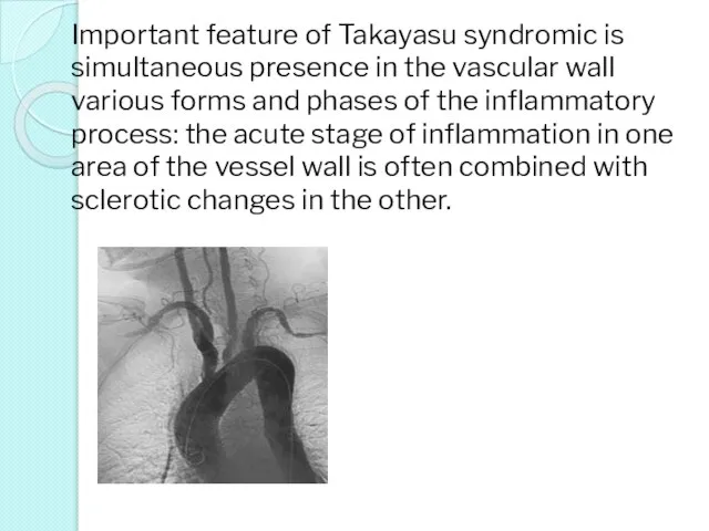 Important feature of Takayasu syndromic is simultaneous presence in the vascular