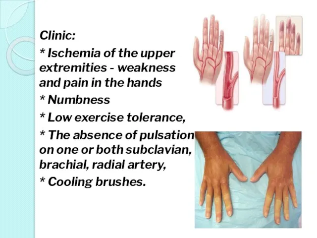 Clinic: * Ischemia of the upper extremities - weakness and pain